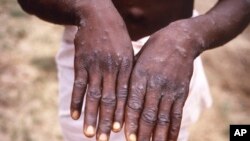 This 1997 image provided by the CDC during an investigation into an outbreak of monkeypox, which took place in the Democratic Republic of the Congo.